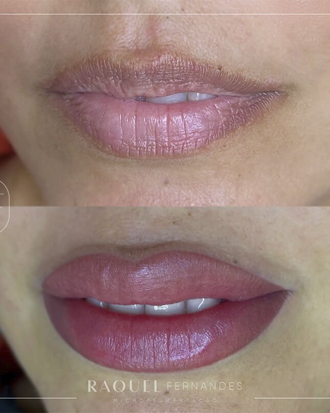 PROCEDIMENTO LÁBIO 1