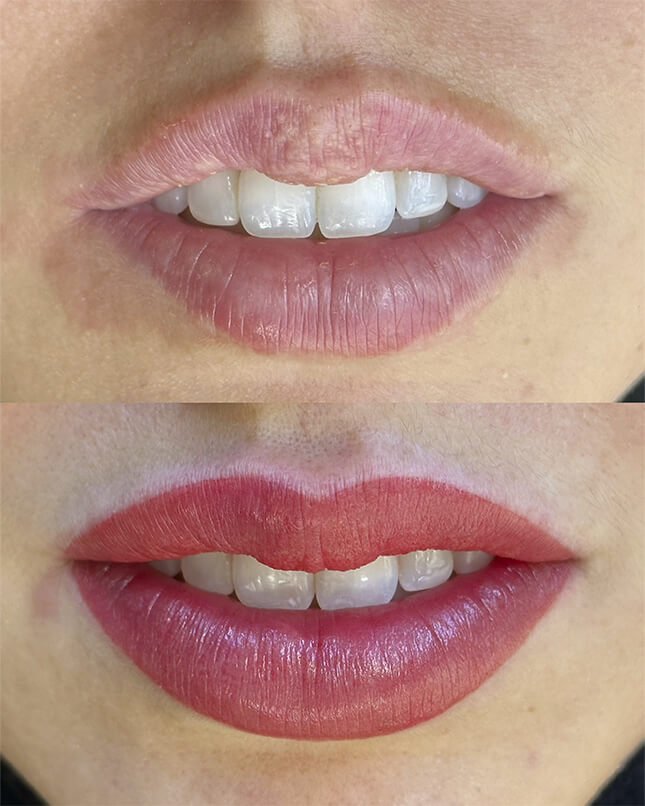 PROCEDIMENTO LÁBIO 2