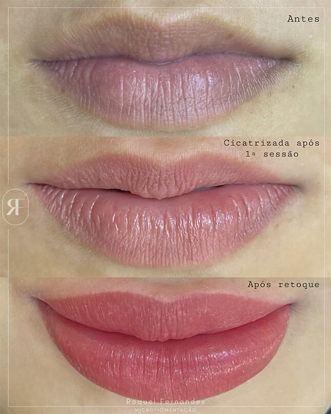 PROCEDIMENTO LÁBIO 3