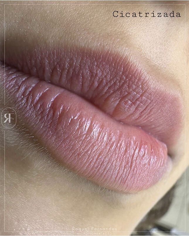 PROCEDIMENTO LÁBIO 4