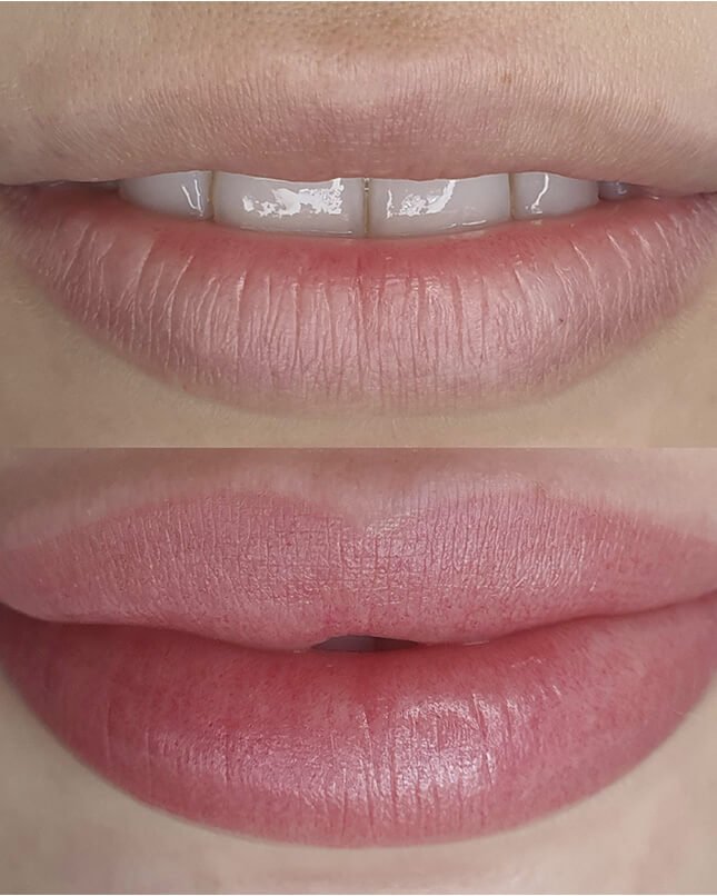 PROCEDIMENTO LÁBIO 5