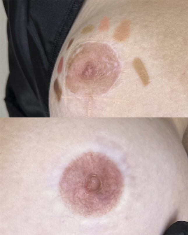 PROCEDIMENTO RECONSTRUÇÃO PARAMÉDICA 1