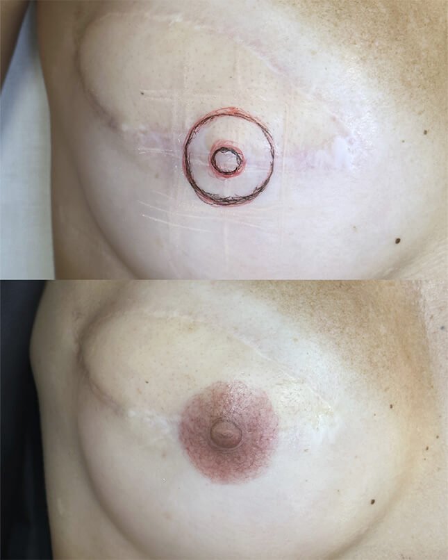 PROCEDIMENTO RECONSTRUÇÃO PARAMÉDICA 3